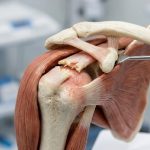 Rupture du tendon